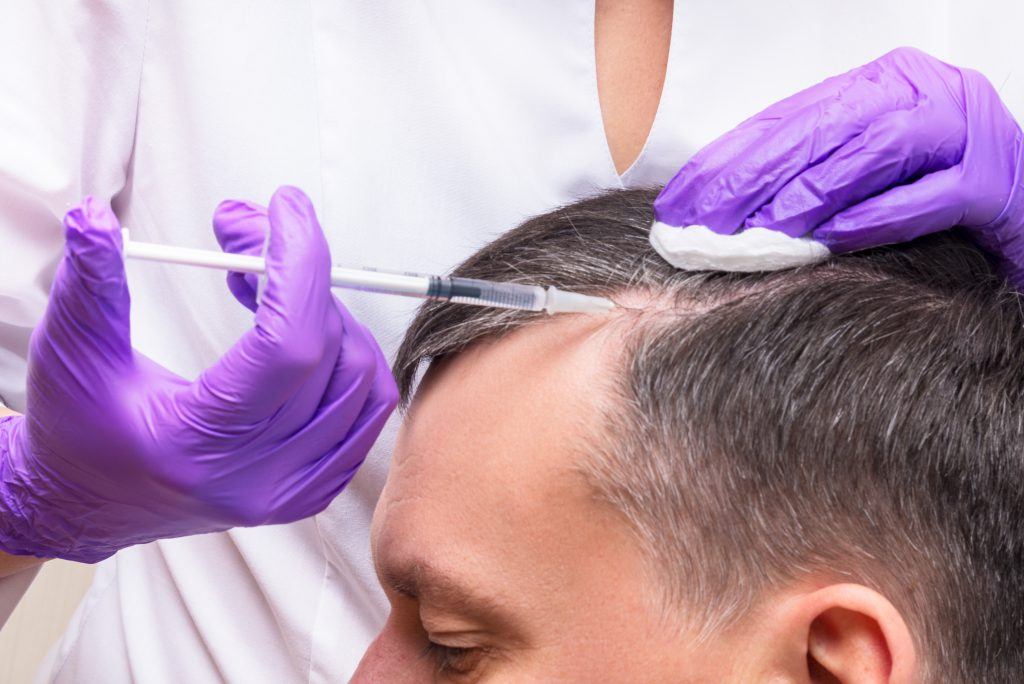 پلاسما تراپی برای درمان ریزش مو