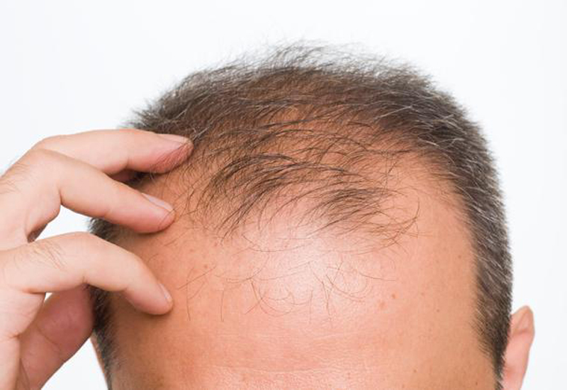 روشهای کاشت مو بدون نیاز به بانک مو