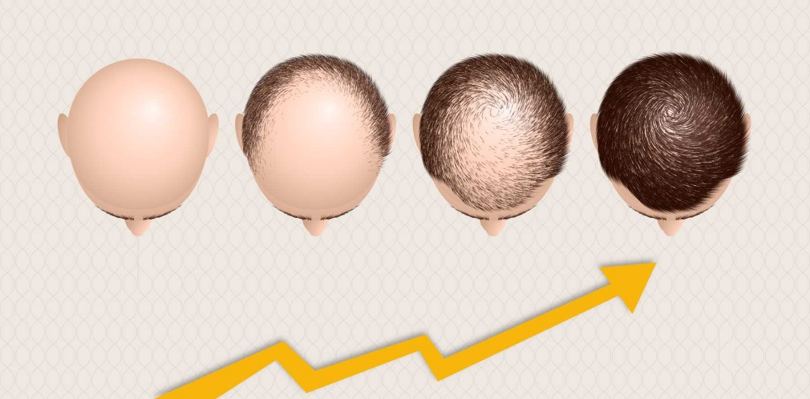 سرعت رشد موها بعد از کاشت