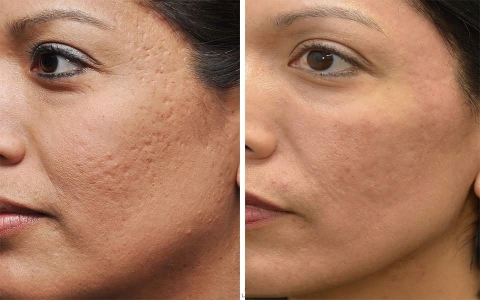 درمان جای جوش صورت با طب سنتی با روش آسان کلینیک صدف