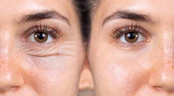 علت کوچک شدن چشم بعد از عمل پلک